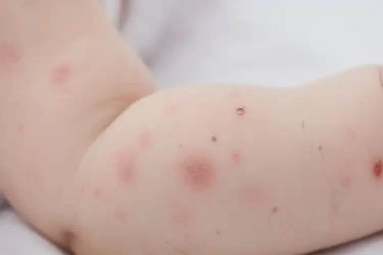 婴幼儿手臂上偶尔长湿疹可以治好吗(图4)