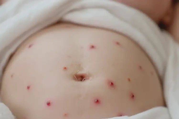婴儿肚子偶尔起湿疹可以治好吗(图4)