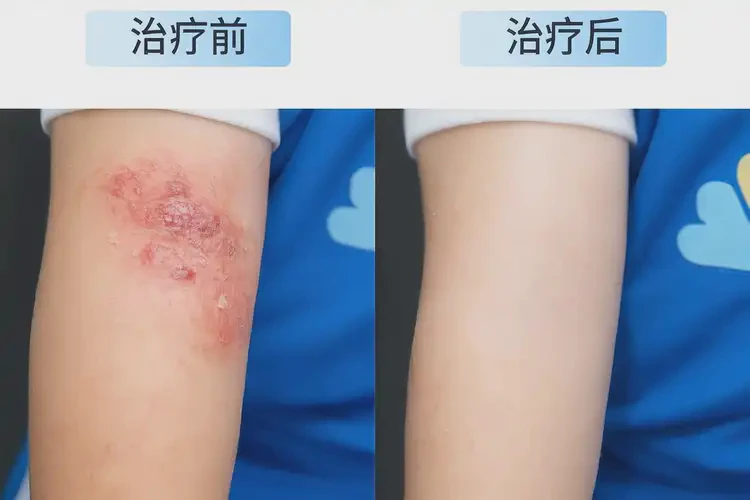 小学生肚子上起湿疹可不可以根治(图4)