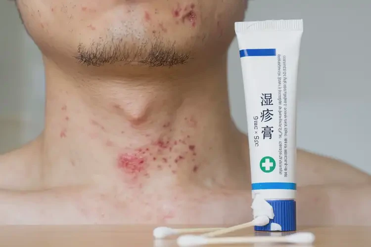 青年人脖子上偶尔长湿疹可不可以根治(图4)