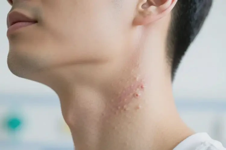 男性脖子有湿疹可以治好吗(图4)