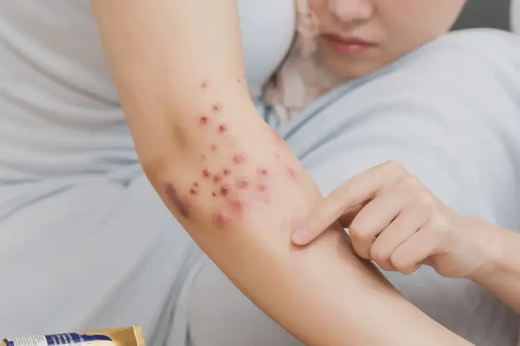孕妇手臂上容易起湿疹可以治好吗(图4)