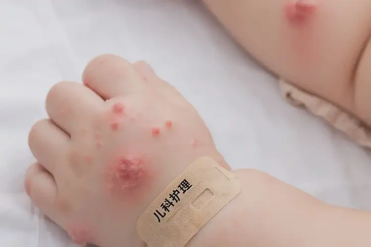 婴儿手臂长湿疹可以治好吗(图4)