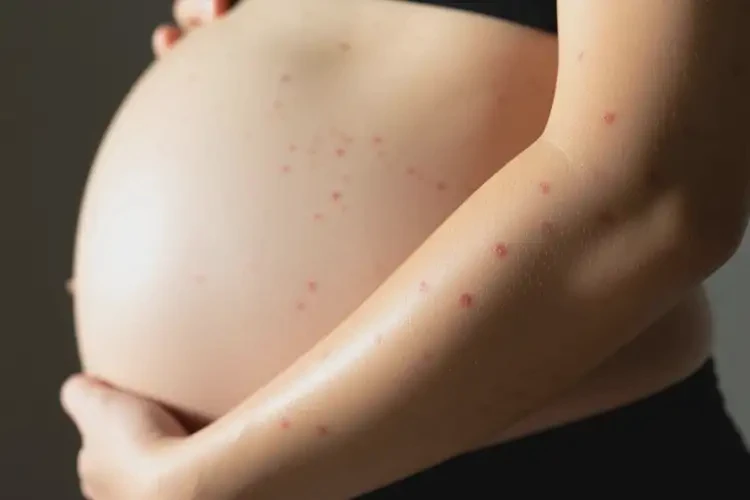 孕妇手臂上偶尔起湿疹可不可以根治(图1)