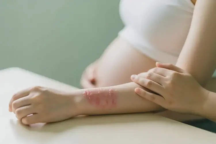 孕妇手臂偶尔起湿疹可以治好吗(图2)