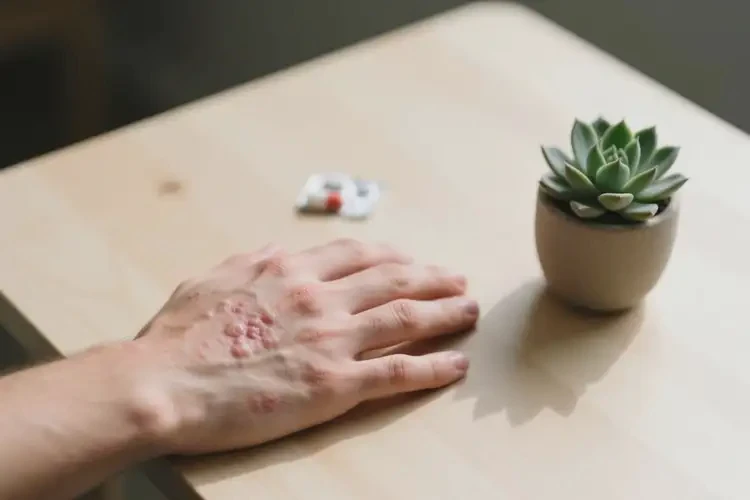 青年人手上起湿疹可不可以根治(图2)