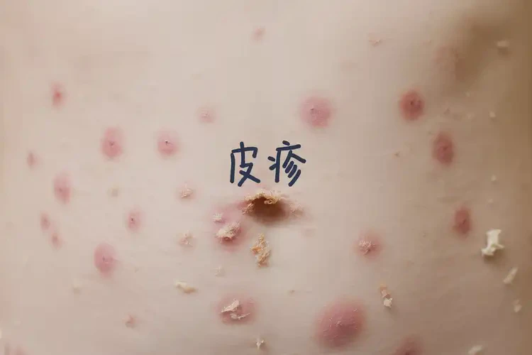 少儿肚子上出湿疹能靠自己自愈吗(图4)