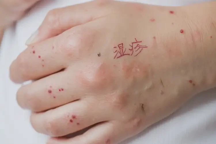 产妇手上有湿疹可不可以根治(图4)