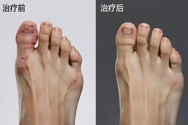 产妇脚上偶尔起湿疹可不可以根治(图1)