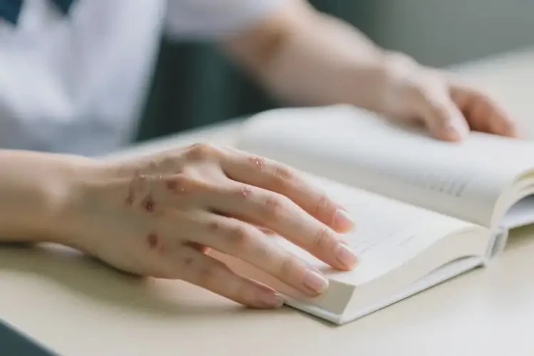 大学生手上长湿疹可不可以根治(图3)