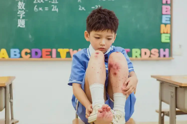 小学生脚上有湿疹可不可以根治(图2)
