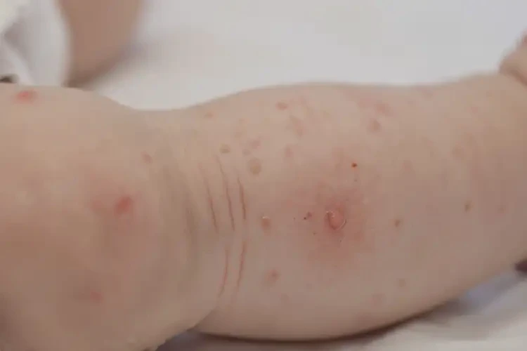宝宝小腿上长湿疹可以治好吗(图4)