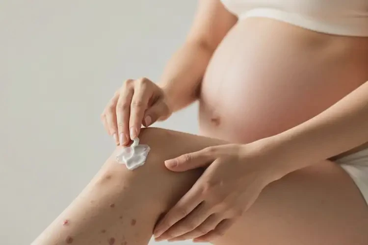 产妇小腿有湿疹可以治好吗(图4)