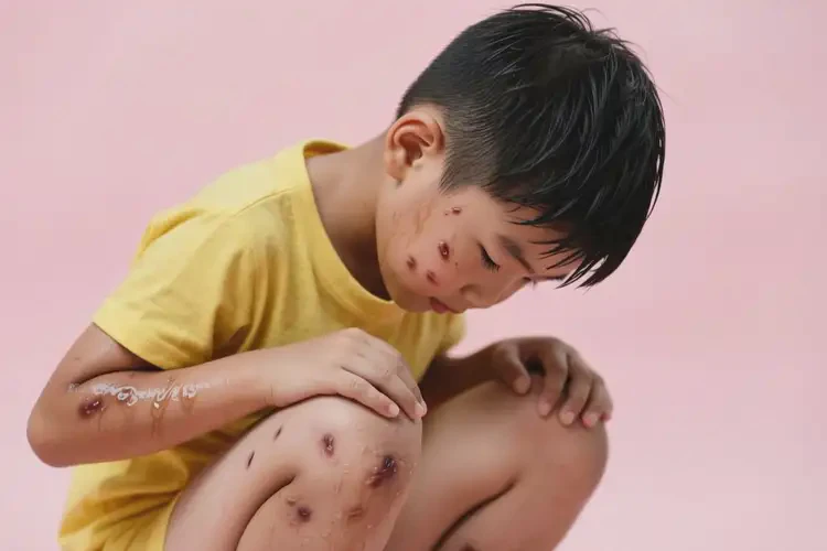 小学生全身出现湿疹可不可以根治(图1)