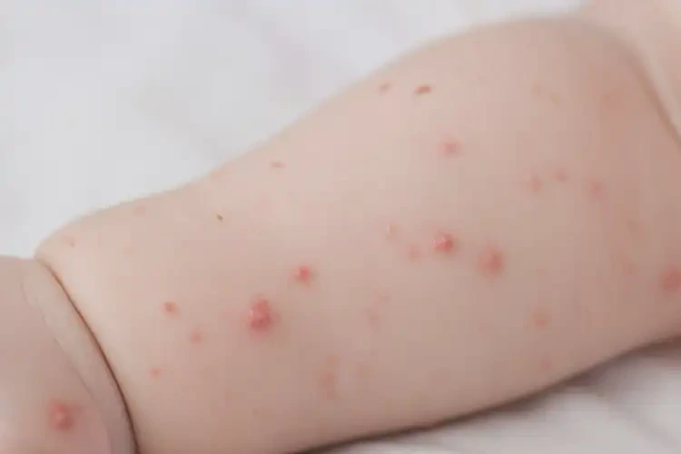 孩子屁股上出现湿疹不管它会自己自愈吗(图4)