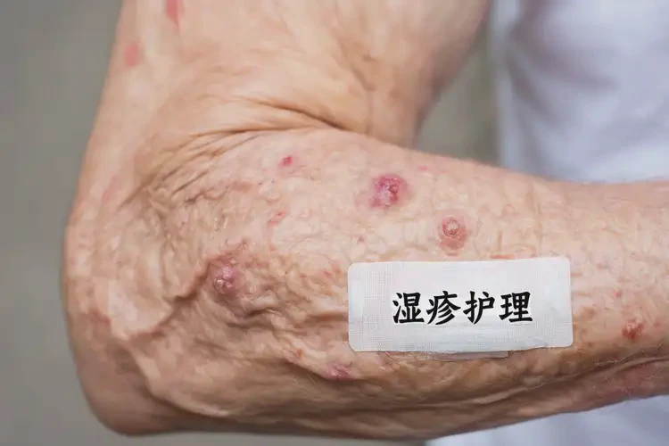 老年人手臂上起湿疹可不可以根治(图4)