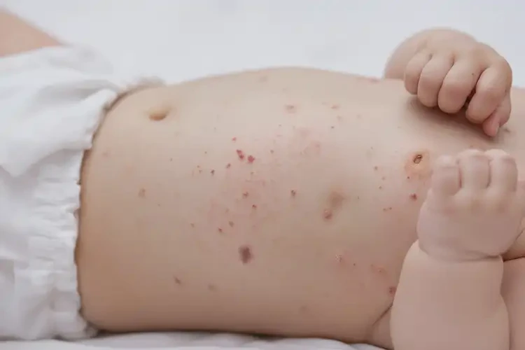 婴幼儿肚子出湿疹能靠自己自愈吗(图4)