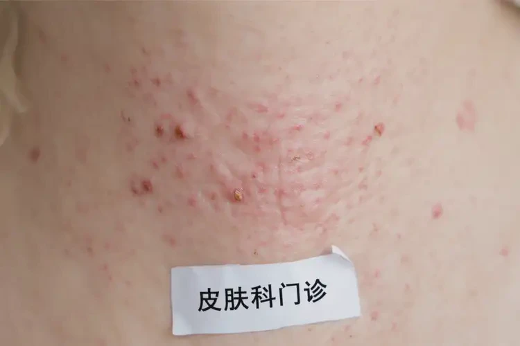 孕妇脖子上出湿疹可不可以根治(图4)