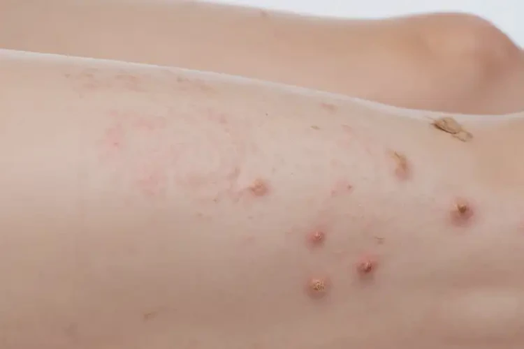 产妇小腿上起湿疹可以治好吗(图4)