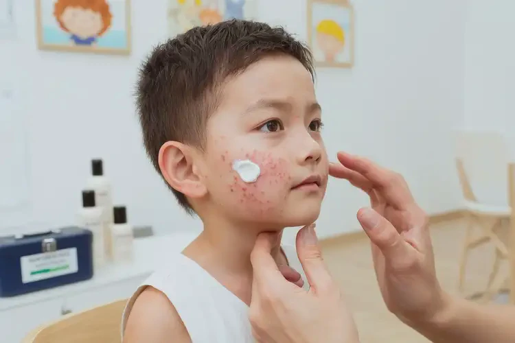 少儿脸上偶尔长湿疹可不可以彻底自愈(图3)