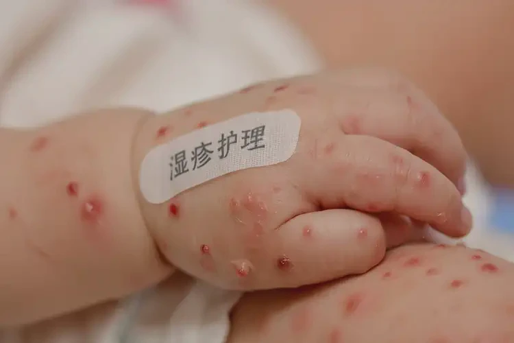 婴儿手上起湿疹可以治好吗(图4)