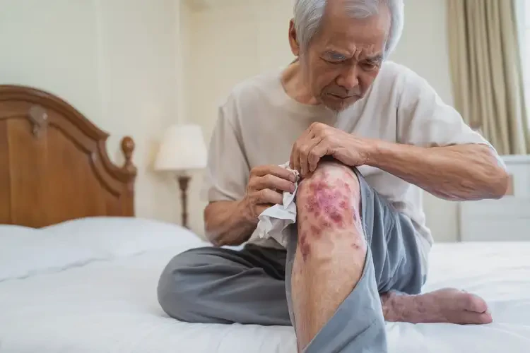 老人大腿容易长湿疹能彻底自愈吗(图4)