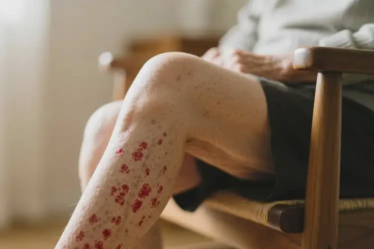 老人大腿上经常起湿疹可不可以根治(图4)