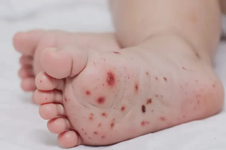 婴幼儿脚上有湿疹可以治好吗(图4)