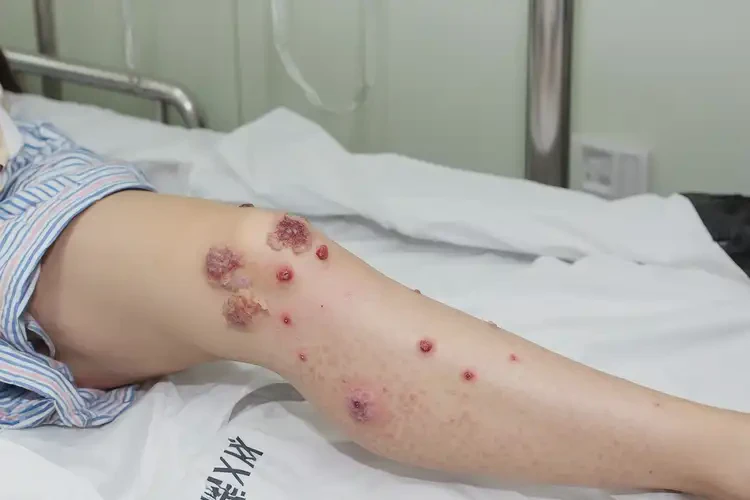 产妇小腿长湿疹可不可以根治(图3)