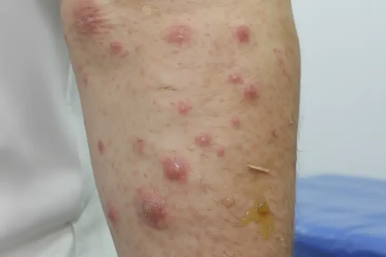 产妇大腿上偶尔长湿疹能靠自己自愈吗(图3)