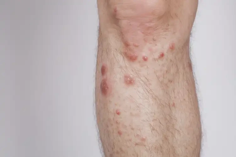 男生小腿有湿疹不管它会自己自愈吗(图1)