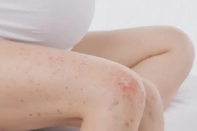 产妇大腿容易长湿疹可不可以根治(图4)