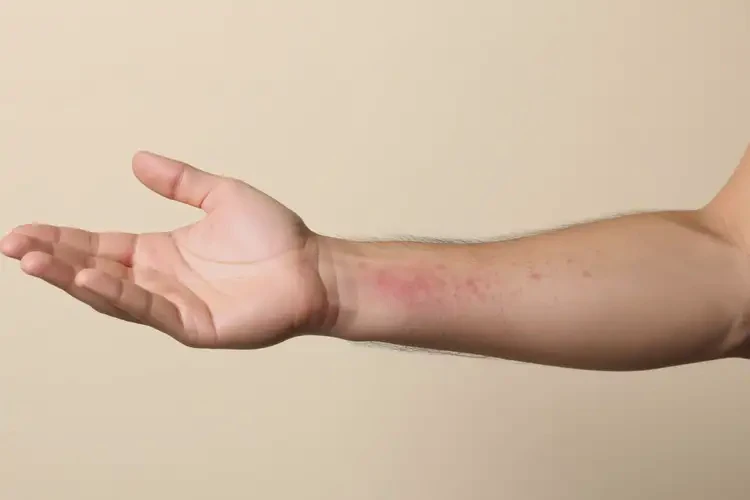 男性手臂容易长湿疹可以治好吗(图4)