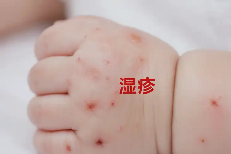 宝宝手上出湿疹可以治好吗(图4)