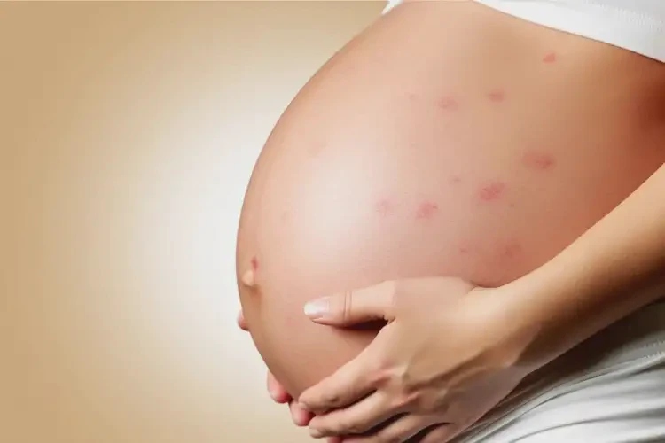孕妇肚子上偶尔起湿疹可以治好吗(图4)