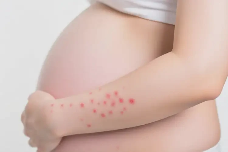 孕妇手臂上有湿疹可不可以根治(图1)