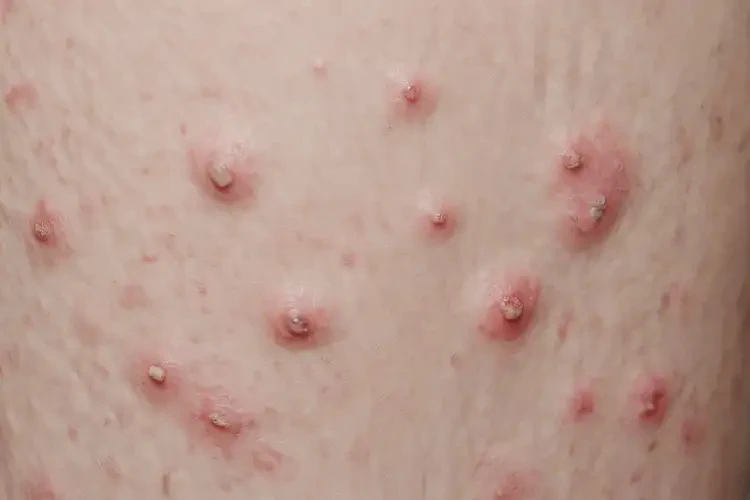男性大腿经常长湿疹可以治好吗(图4)