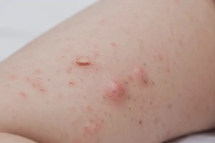 婴幼儿大腿上长湿疹可以治好吗(图4)