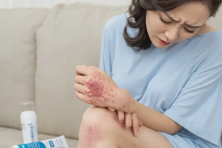孕妇手上起湿疹可不可以根治(图4)