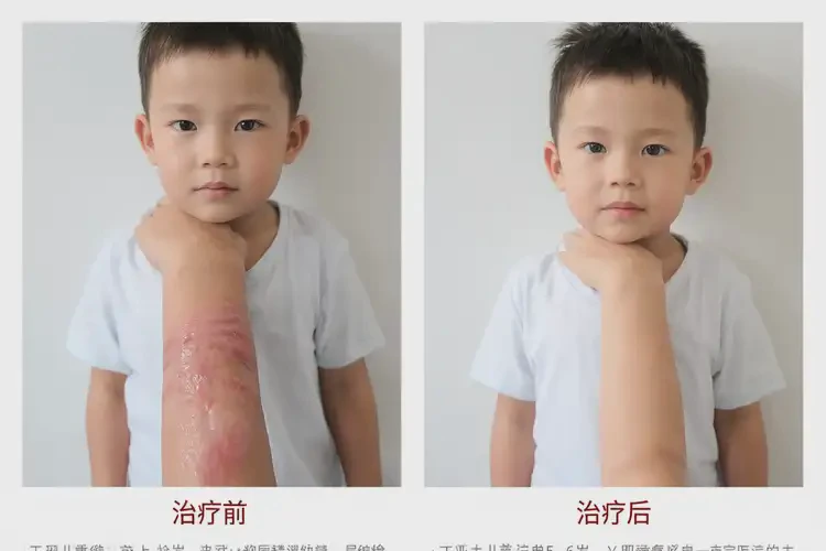 小孩脸上经常长湿疹可以治好吗(图4)