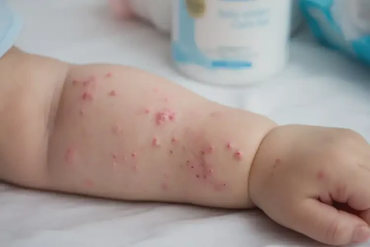 宝宝手臂上起湿疹可以治好吗(图4)