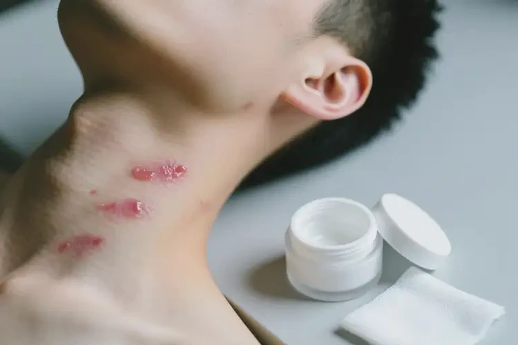 男性脖子偶尔起湿疹可以治好吗(图1)