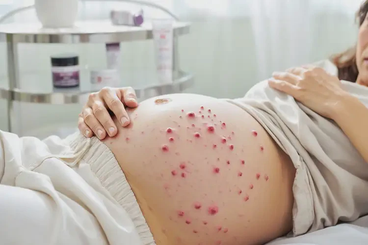 孕妇肚子上经常起湿疹可不可以根治(图4)