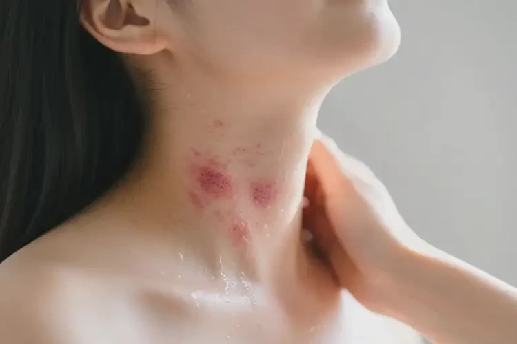 产妇脖子出现湿疹可不可以根治(图4)