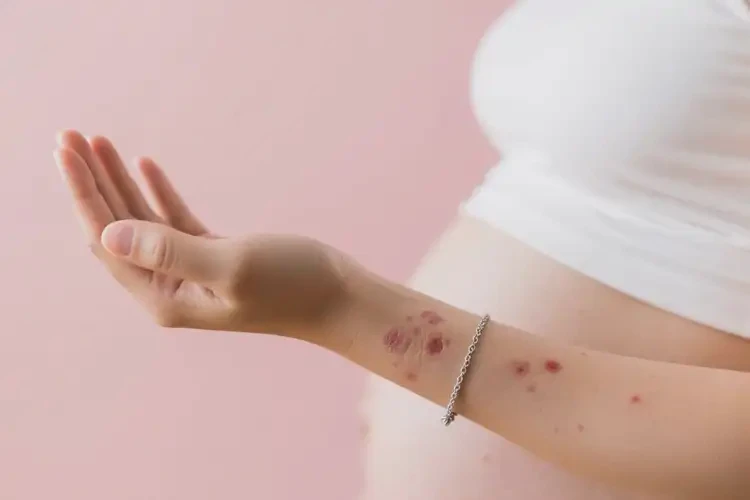 孕妇手臂上有湿疹可不可以根治(图2)
