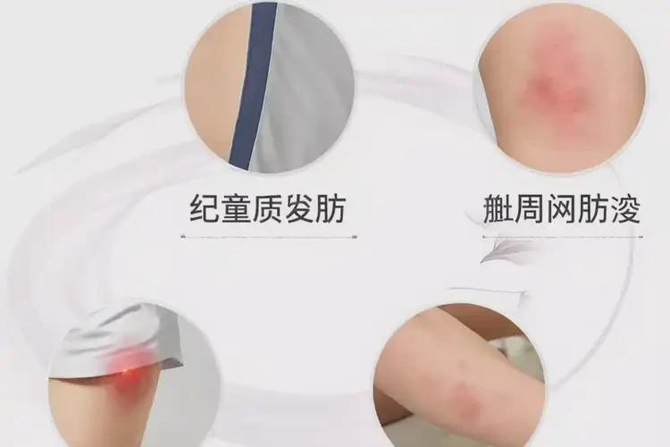 小学生肛周经常长湿疹可不可以根治(图4)