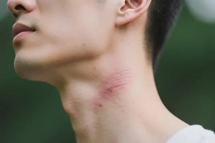 男性脖子有湿疹可以治好吗(图1)