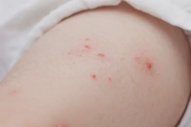 婴幼儿大腿上出现湿疹能彻底自愈吗(图4)