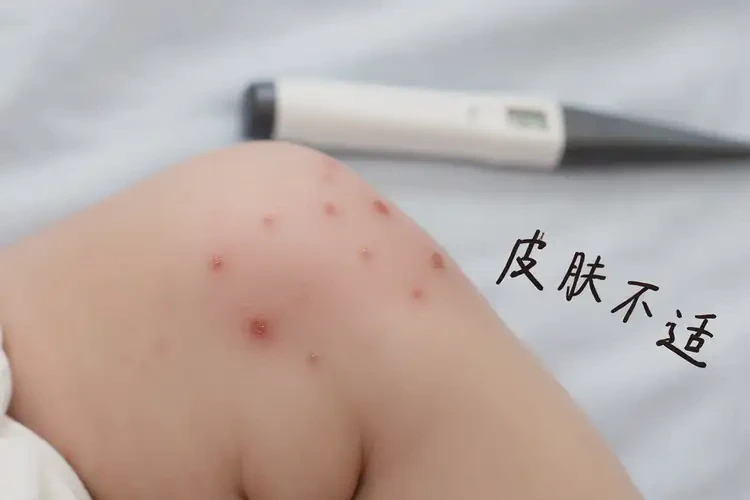 宝宝小腿容易起湿疹可以治好吗(图4)