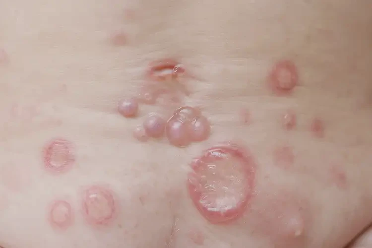 婴儿肛周经常起湿疹可以治好吗(图4)